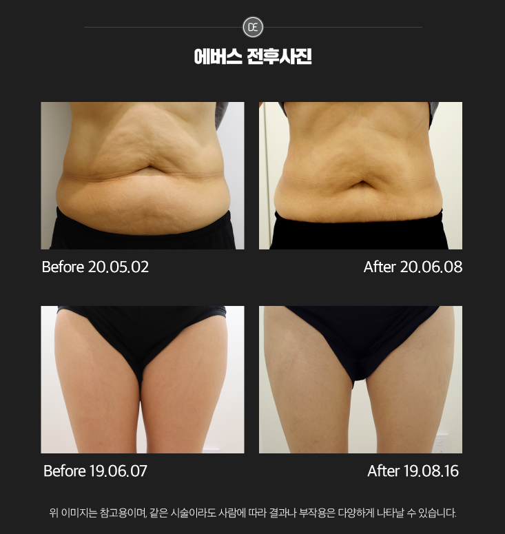 바디지방분해주사 송도피부과 닥터에버스 바디지방분해주사 송도피부과 닥터에버스