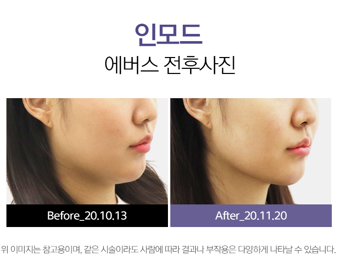 인모드FX전후 송도피부과 닥터에버스 인모드FX전후 송도피부과 닥터에버스