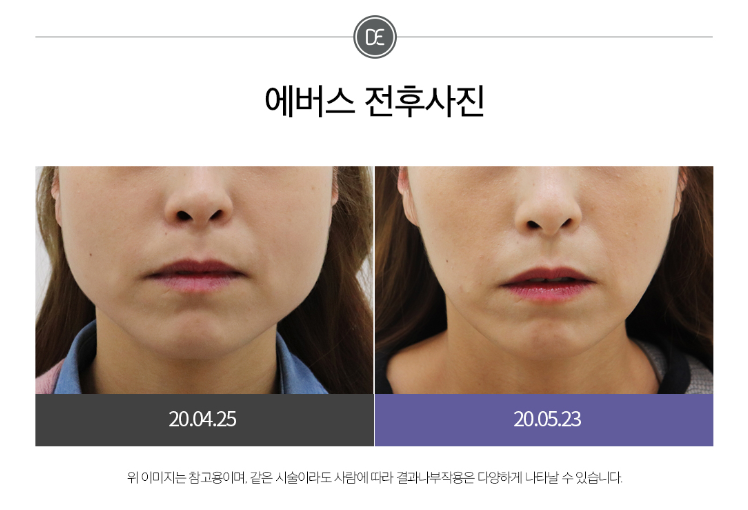 사각턱보톡스전후 송도피부과 닥터에버스 사각턱보톡스전후 송도피부과 닥터에버스